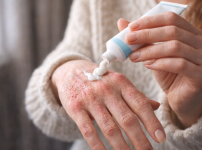 튼 손에 보습제를 바르는 여성