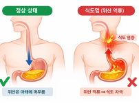 식도염.png