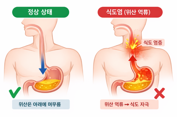 식도염.png